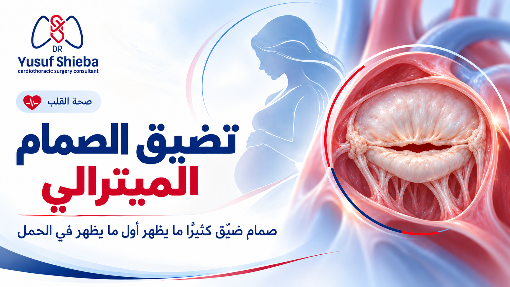 تضيق الصمام الميترالي: صمام ضيّق كثيرًا ما يظهر أول ما يظهر في الحمل