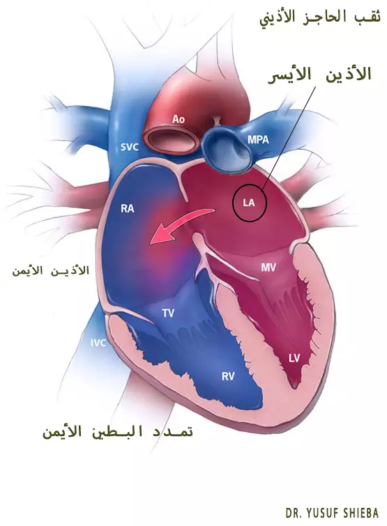 آلية عمل القلب في وجود ثقب القلب الاذيني