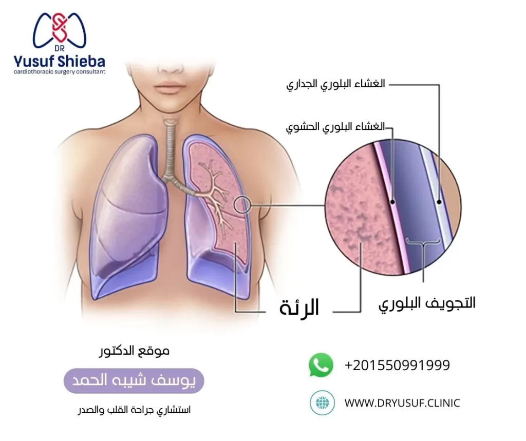 التجويف البلوري - دكتور يوسف شيبه الحمد