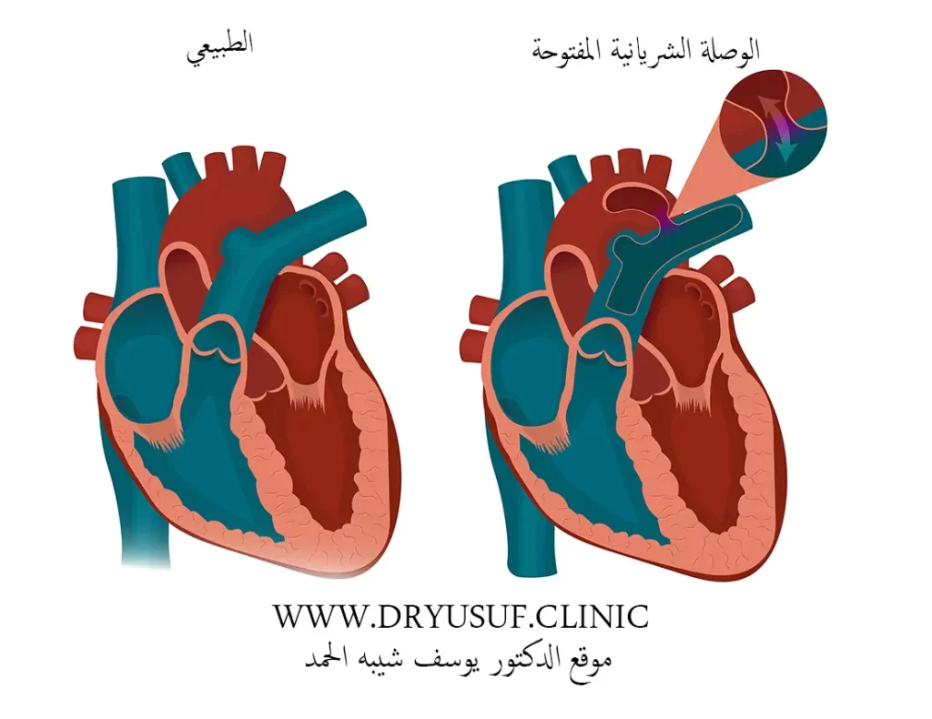 الوصلة الشريانية المفتوحة